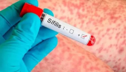 Se disparó el número de casos de sífilis en la Argentina