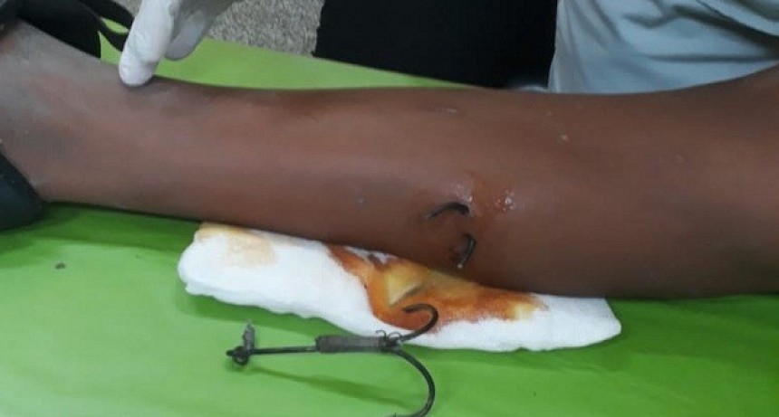 Villa &Aacute;ngela: BOMBEROS Y PERSONAL DE SALUD TRABAJARON JUNTOS PARA EXTRAER UNA PATEJA INCRUSTADA EN LA PIERNA DE UN NI&Ntilde;O  DE 11 A&Ntilde;OS 